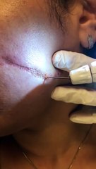 Yüzünüzde oluşmuş falçata - jilet - bıçak izleri