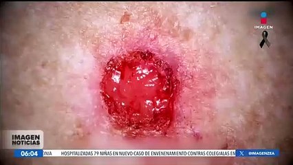 Cáncer de piel: Causas y cifras en México