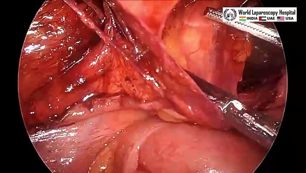 Transabdominal Preperitoneal TAPP Inguinal Hernia Repair A video entire procedure Overview