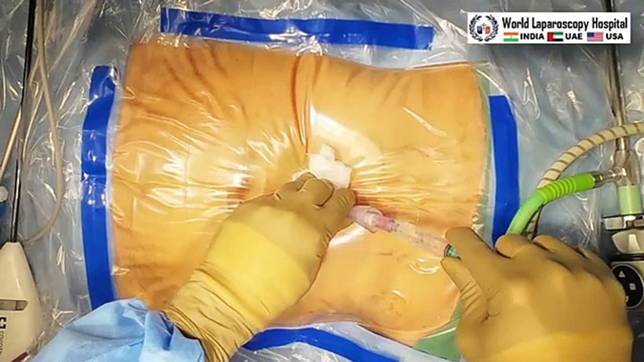Total Laparoscopic Hysterectomy with Appendectomy in a Patient having Myomas  Two Cesarean section