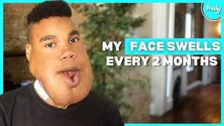 My Giant Facial Tumour Won’t Stop Me Dancing | BORN DIFFERENT