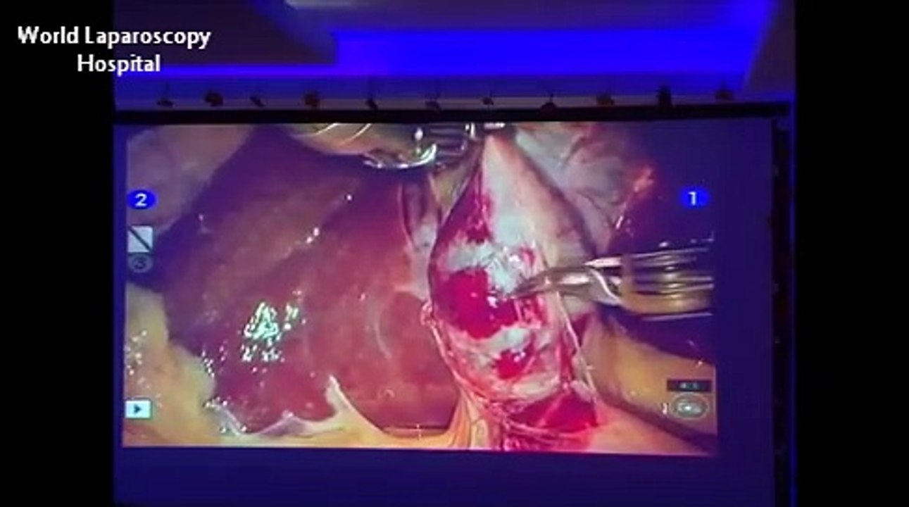 Dr R K Mishra - Performing Robotic Surgery in World Congress of Laparoscopic Surgeons