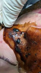 Blackhead removal mask