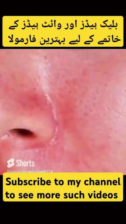 بلیک ہیڈز اور وائٹ ہیڈز کے لیے بہترین گھریلو ٹوٹکا ..#skincare #cosmatics #beautycream #youtubeshor (1)