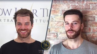 Hair Transplant Before and After | Hair Transplant Results