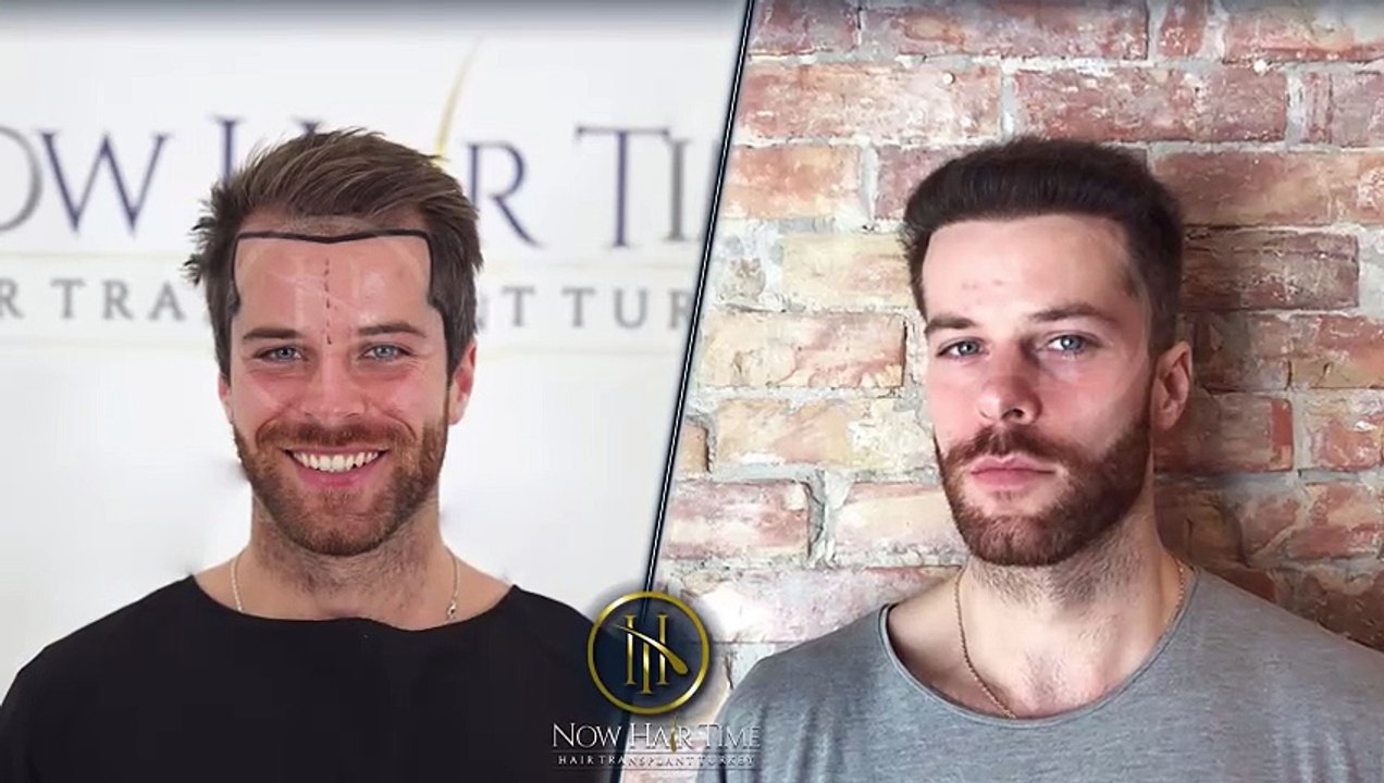 Hair Transplant Before and After | Hair Transplant Results