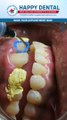 Smile Designing in Vijayawada | Happy Dental India | Dental Veneers