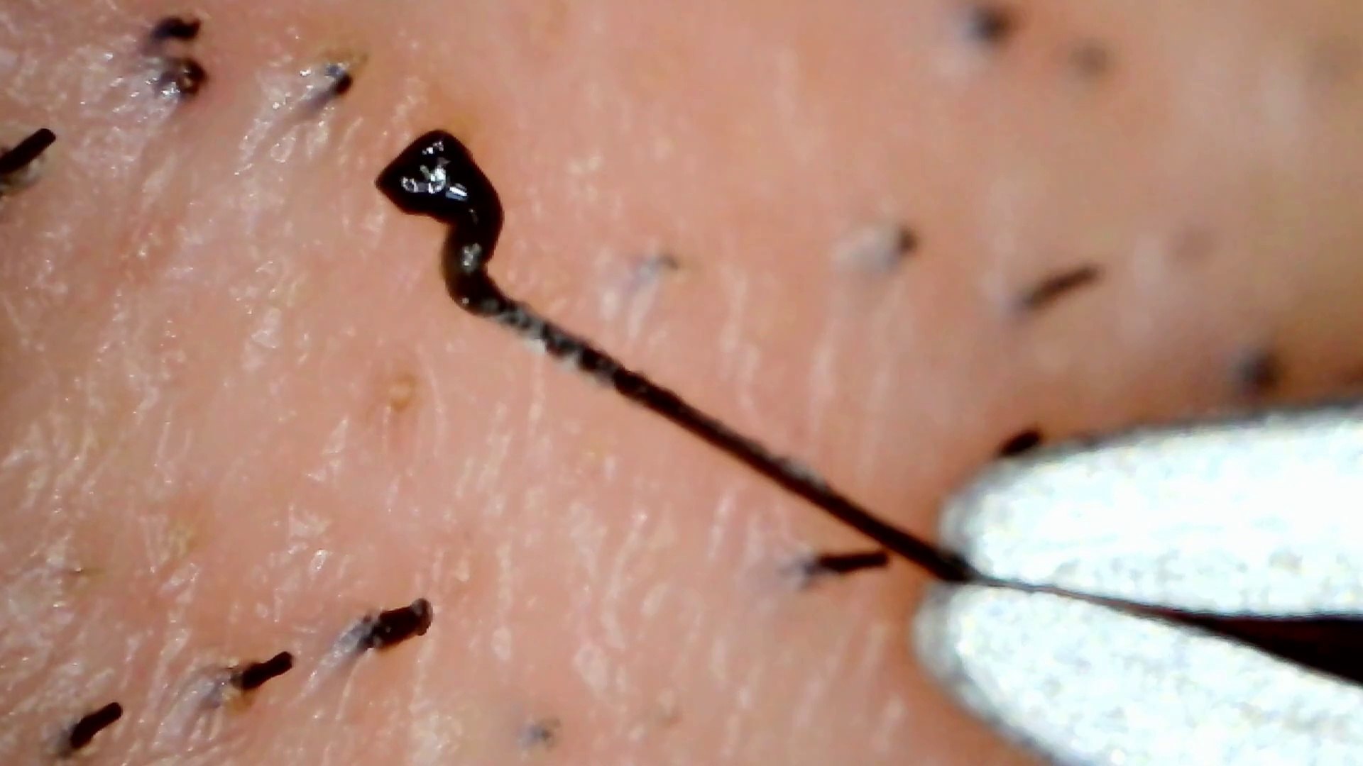 ⁣Microscopic beard removal. / Élimination microscopique de la barbe. #03