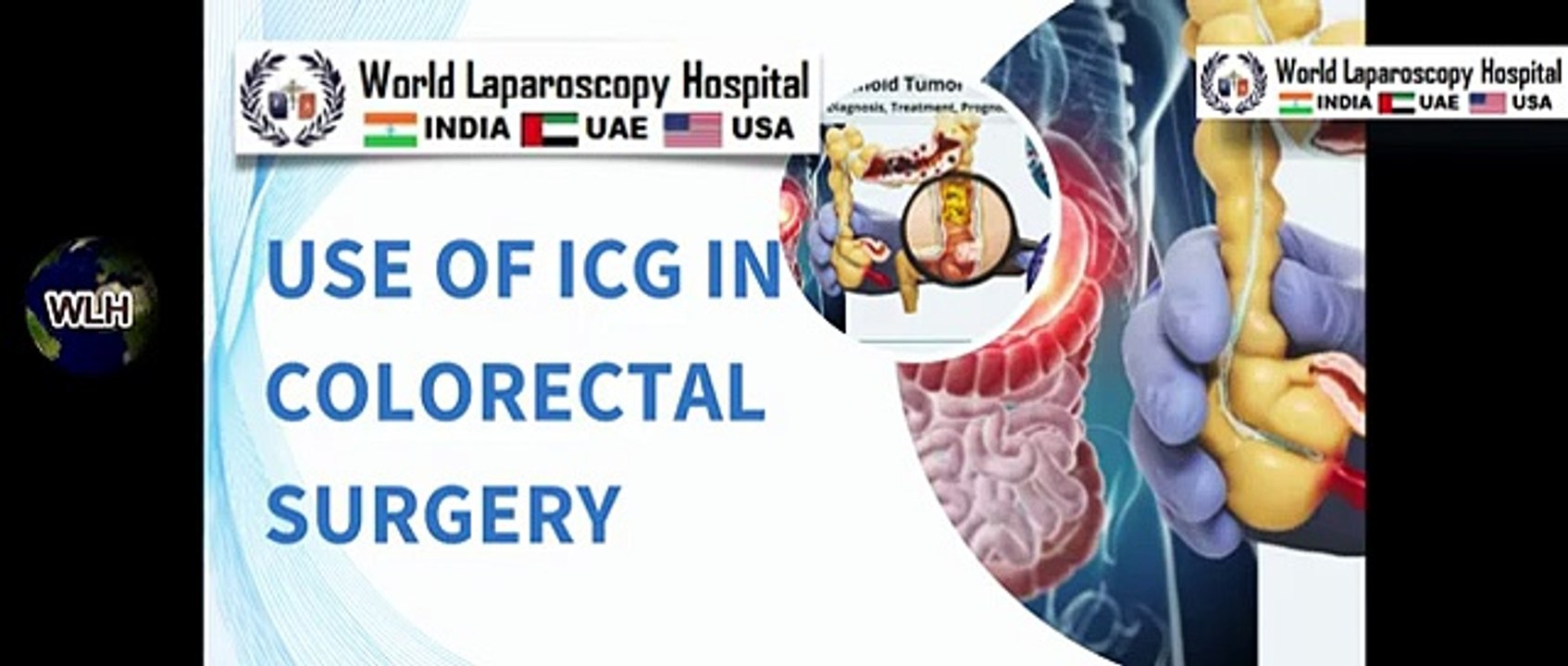Exploring the Use of Indocyanine Green ICG in Colorectal Surgery ...