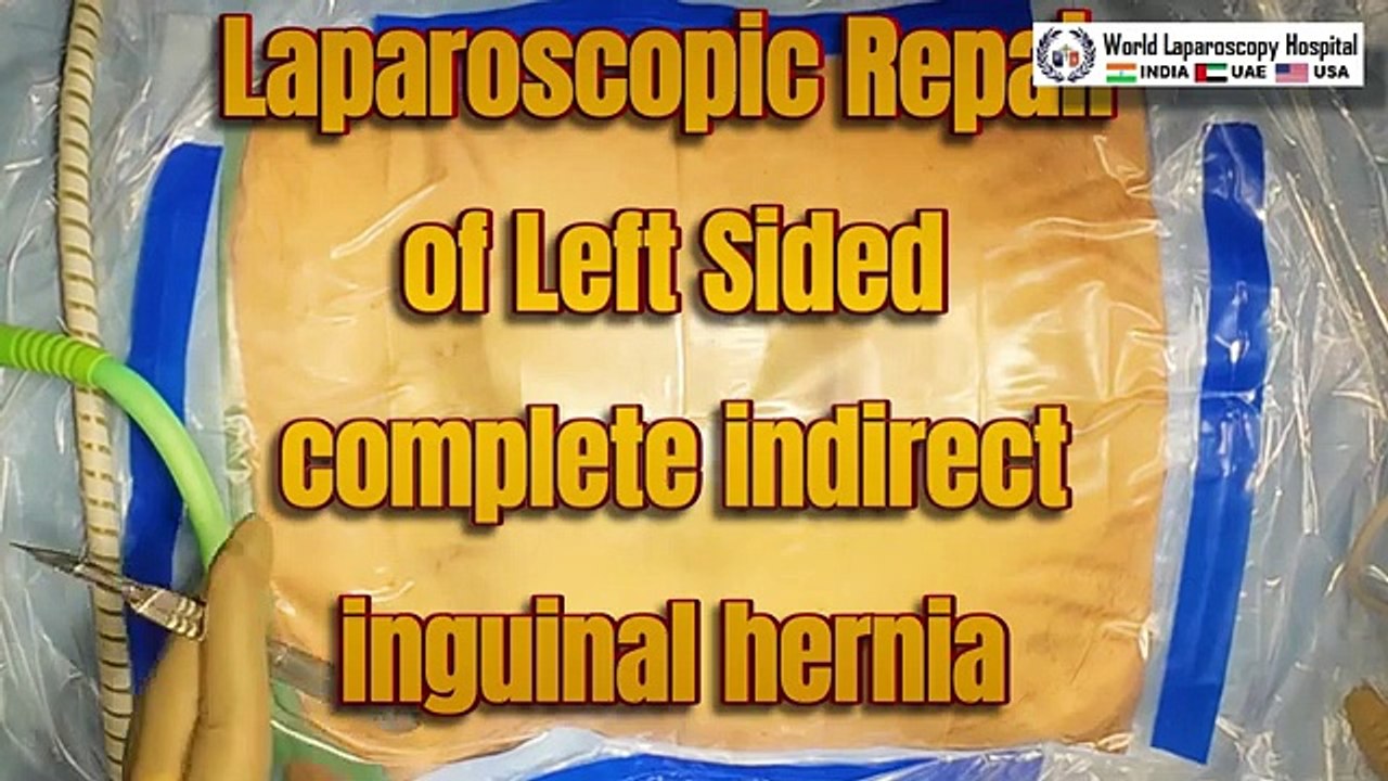 Laparoscopic Repair of Left-Sided Complete Indirect Inguinal Hernia Skin to Skin Surgery Video