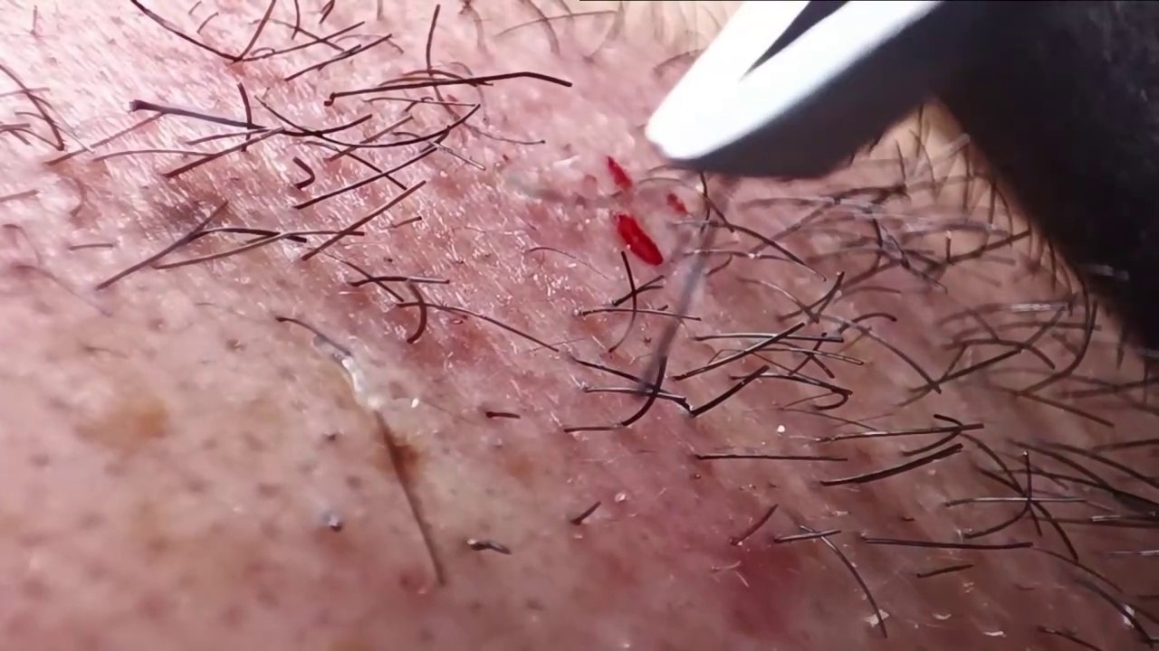 Tweezers to invade the bearded planet　/　Des pincettes pour envahir la planète des barbus