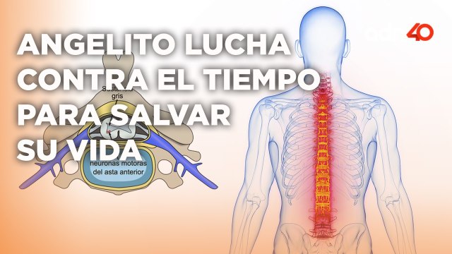 Angelito sufre de una enfermedad poco común que daña los huesos y avanza rápidamente