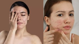 Body Heat Increase से Pimple होता है क्या, Doctor's Advice | Boldsky
