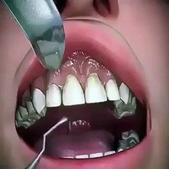 Dental Scaling - Hiegene &  Aesthetics Care