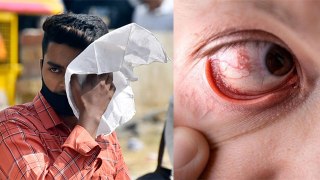 Eye S-troke Kya Hai | Eye Stoke Kese Hota Hai | Eye S-troke Symptoms & Treatment In Hindi
