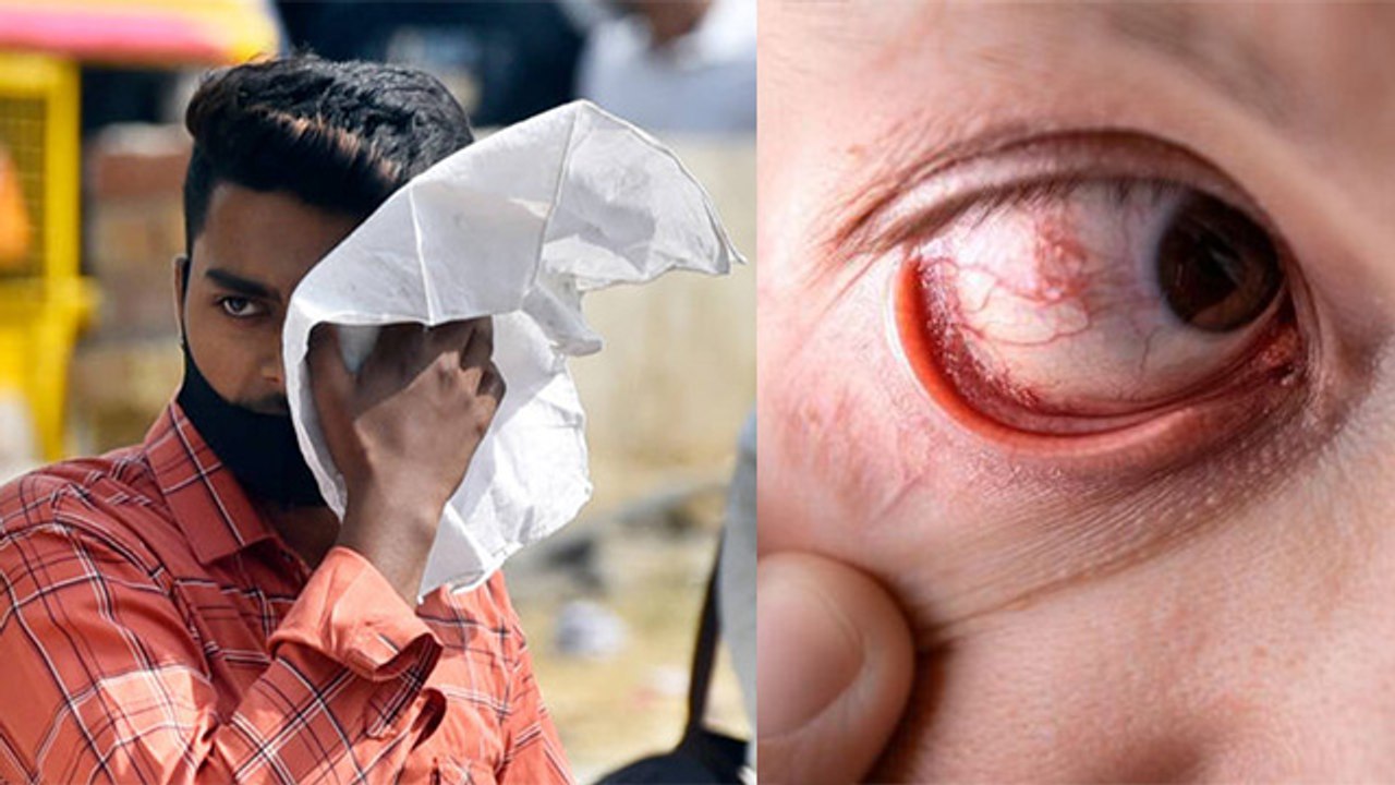 Eye S-troke Kya Hai | Eye Stoke Kese Hota Hai | Eye S-troke Symptoms & Treatment In Hindi