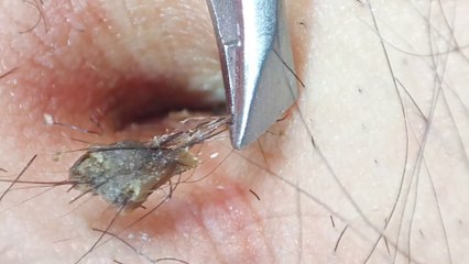 Nettoyage du nombril / Cleaning the navel