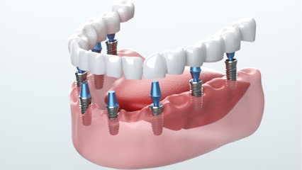 Zahn-OP mit unangenehmen Folgen: Frau aus Texas (USA) hat unerwartet starke Nachwirkungen