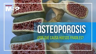 Osteoporosis: ¿Por qué causa huesos frágiles?