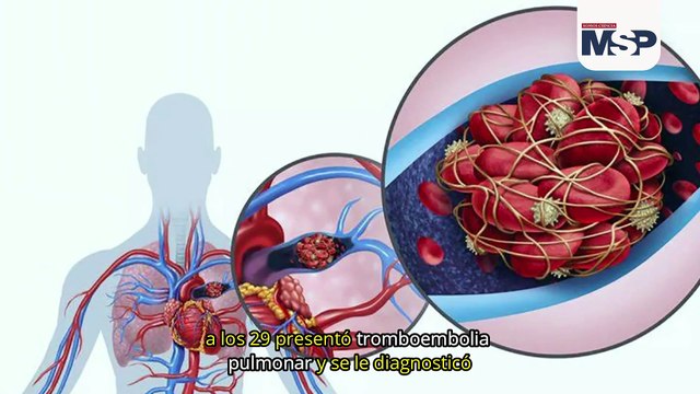 Complicación cardíaca en paciente con lupus: infarto agudo de miocardio - #MSP