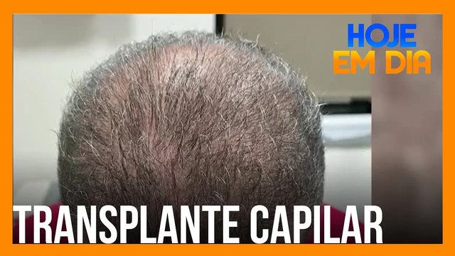 Homens mais velhos se rendem aos benefícios do transplante capilar