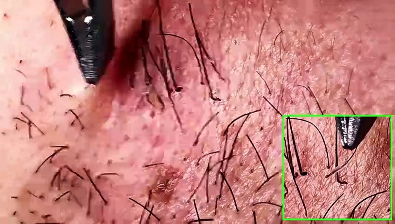 Retirer la barbe à l'aide d'une pince à épiler / Remove the beard with tweezers.