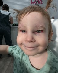 Toddler born visually impaired opens her eyes properly thanks to corrective surgery!