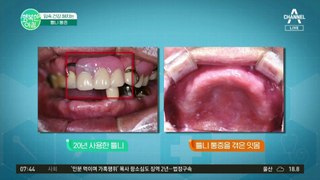 [닥터하우스] 치아 건강을 지키는 법! 수술 피로도와 비용을 줄이는 디지털 임플란트 치료 #틀니