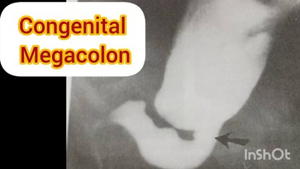 Congenital Megacolon/learn clinical anatomy