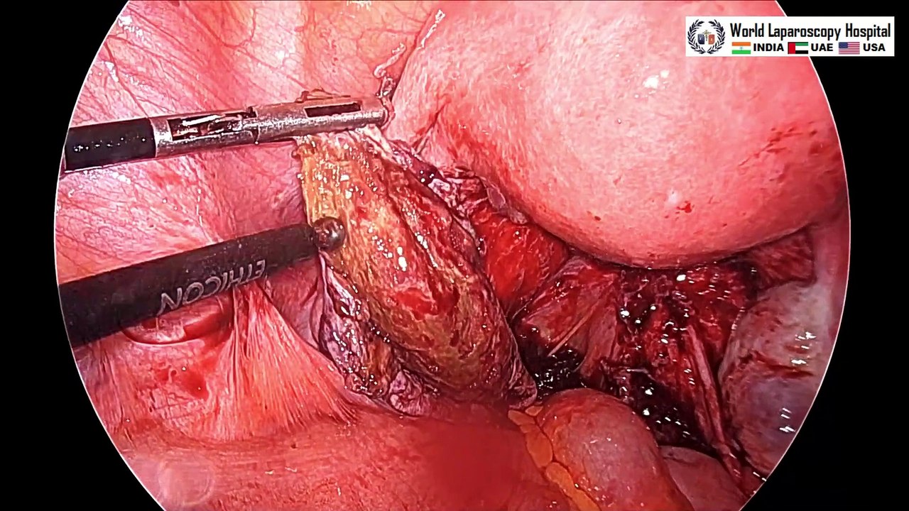 Laparoscopic ablation of endometriosis using Ultrasonic Energy