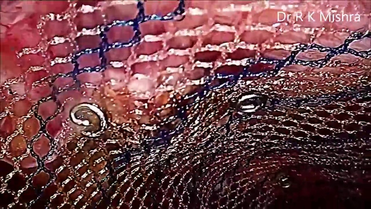IPOM Laparoscopic Inguinal Hernia Repair