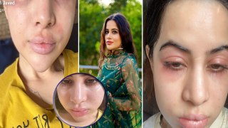 Urfi Javed Face Swollen After Allergy Emotional Post Viral, Fans Shocking Reaction Viral | Boldsky