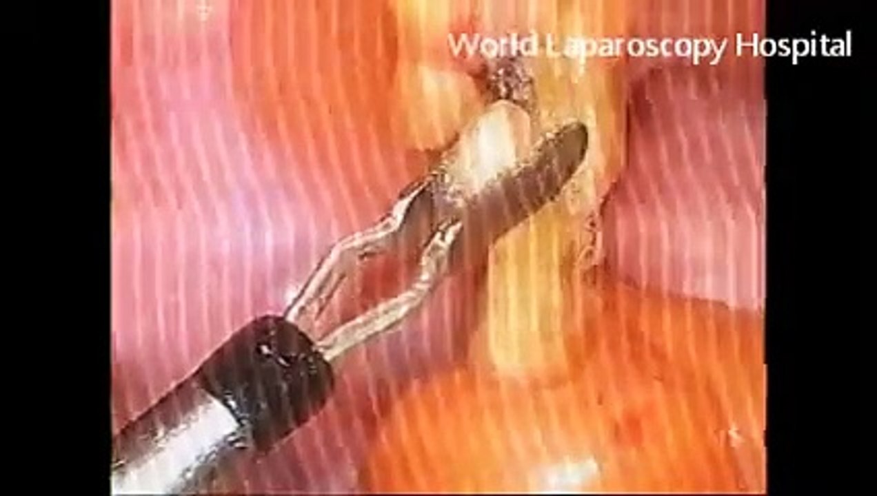 Laparoscopic Appedndicectomy