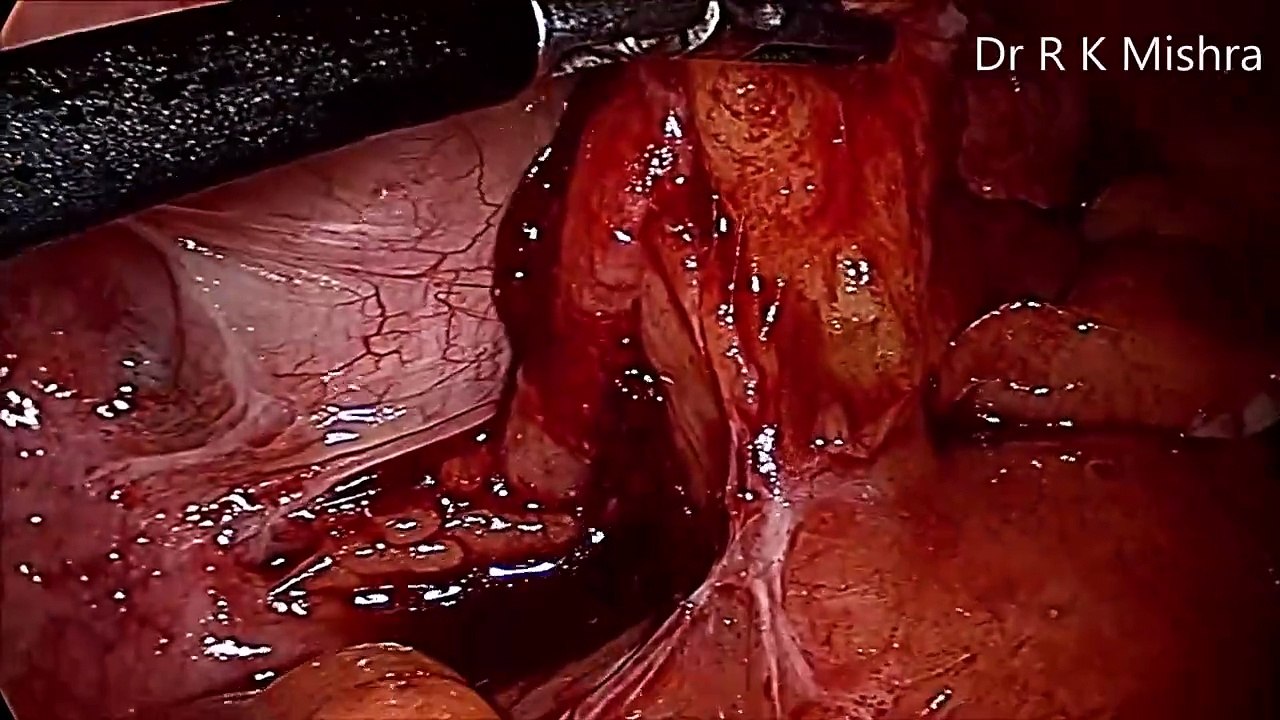 Laparoscopic Appendectomy - Immediate Laparoscopy is Ideal for Acute Appendicitis