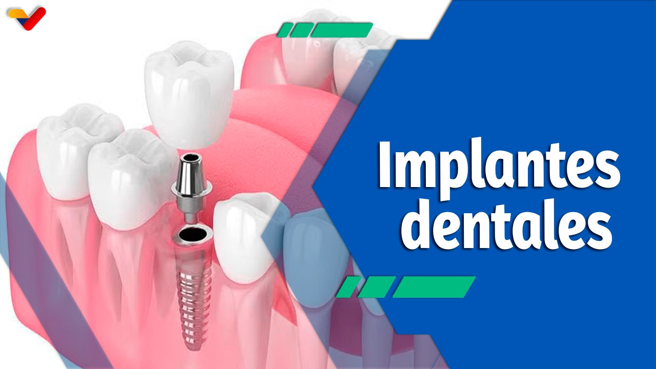 Actitud Saludable | Implantes dentales: un procedimiento que reemplaza las raíces de los dientes