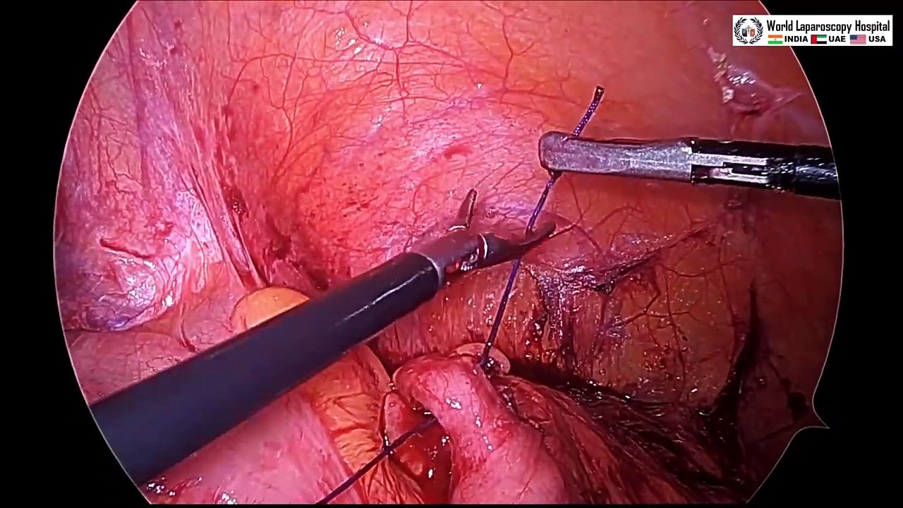 Laparoscopic Appendectomy for Acute Appendicitis (Retrocecal Appendix)
