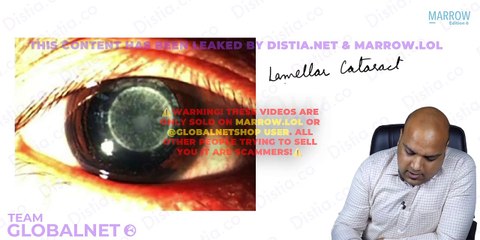 Lens - Congenital cataract, Ectopía lentis yw opthalmology