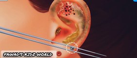 ASMR ear surgery animation video / Surgical 3D animation 