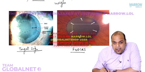 Secondary and congenital glucoma yw opthalmology