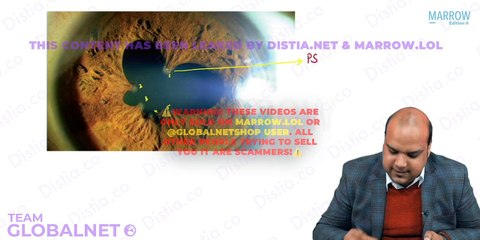 Anterior uveitis yw opthalmology