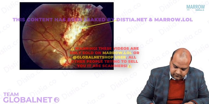 Uvea intermediate posterior pan uveitis opthalmology