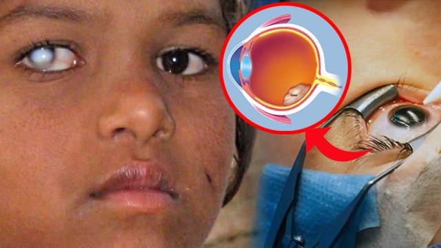 White Spot Inside Eyeball Reason & Treatment: Aankh Me Safed Daag Ka Ilaj | Boldsky