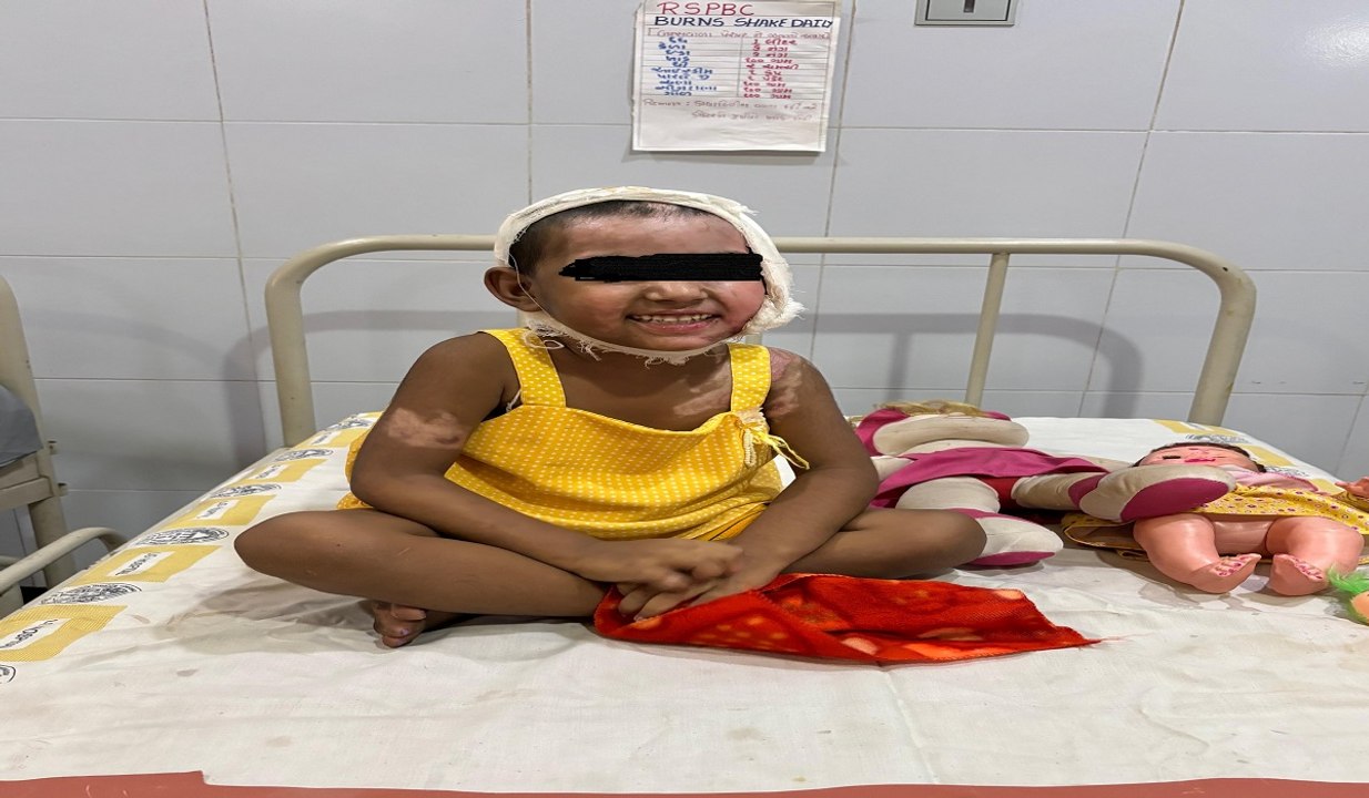 अहमदाबाद में झुलसी अवस्था में लावारिस मिली बालिका हुई स्वस्थ