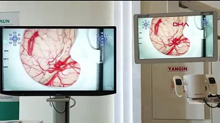 Anevrizmanın genetik şifrelerini bir Türk çözecek. Yaklaşık 7 bin kişi 5 yıl boyunca takip edilecek