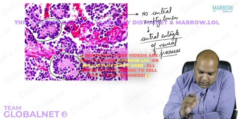 Retinablastoma and macular disorder yw opthalmology