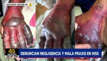 Paciente en riesgo de perder su mano por negligencia médica en el IHSS