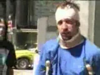 Caméra cachée à la jambe cassée