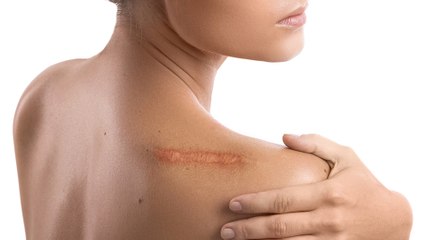 bd-como-cuidar-una-cicatriz-luego-de-una-operacion-140624