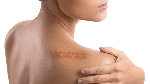 bd-como-cuidar-una-cicatriz-luego-de-una-operacion-140624