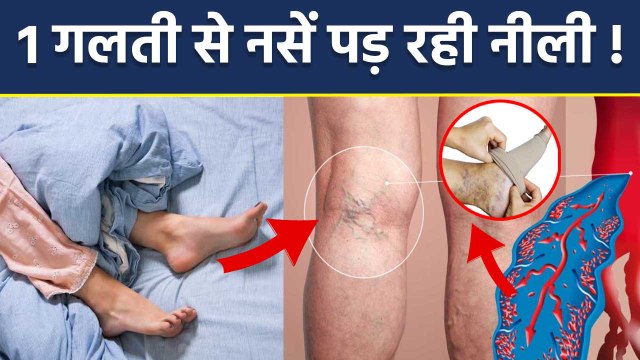 Varicose Vein Treatment In Hindi: Neeli Naso Ka Ilaj, Leg Movement To Weight Control..| Boldsky